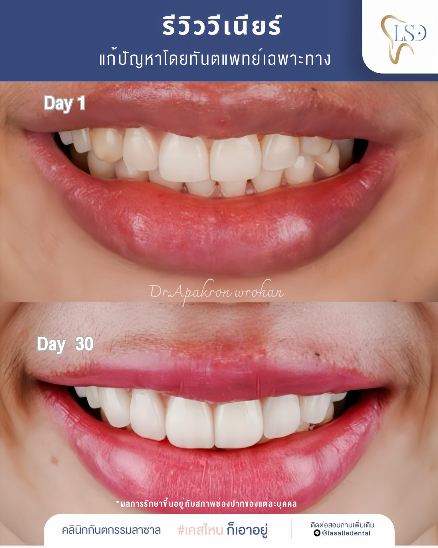 รีวิวจัดฟัน – 23