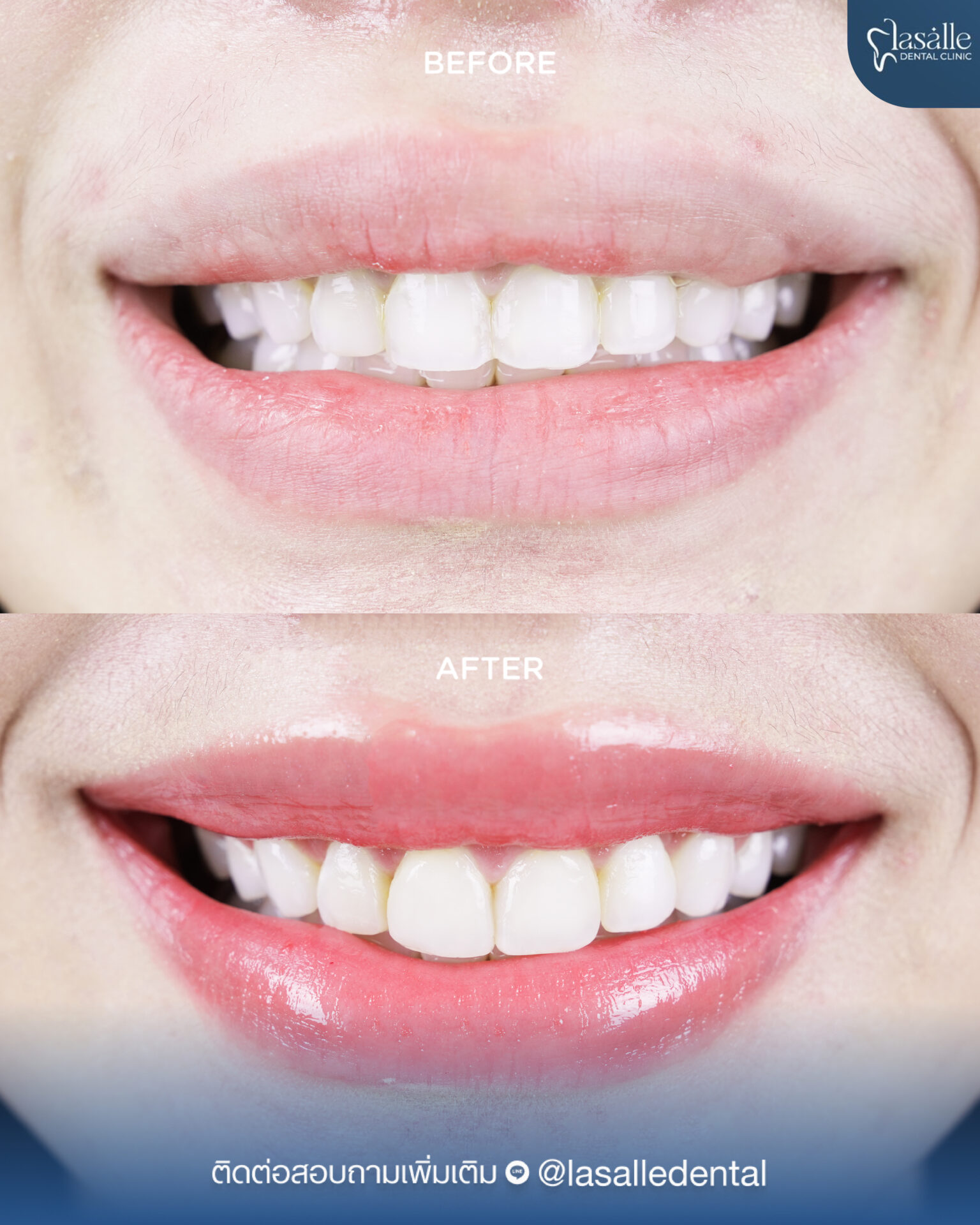 135.Lasalle – Before After คนไข้-01