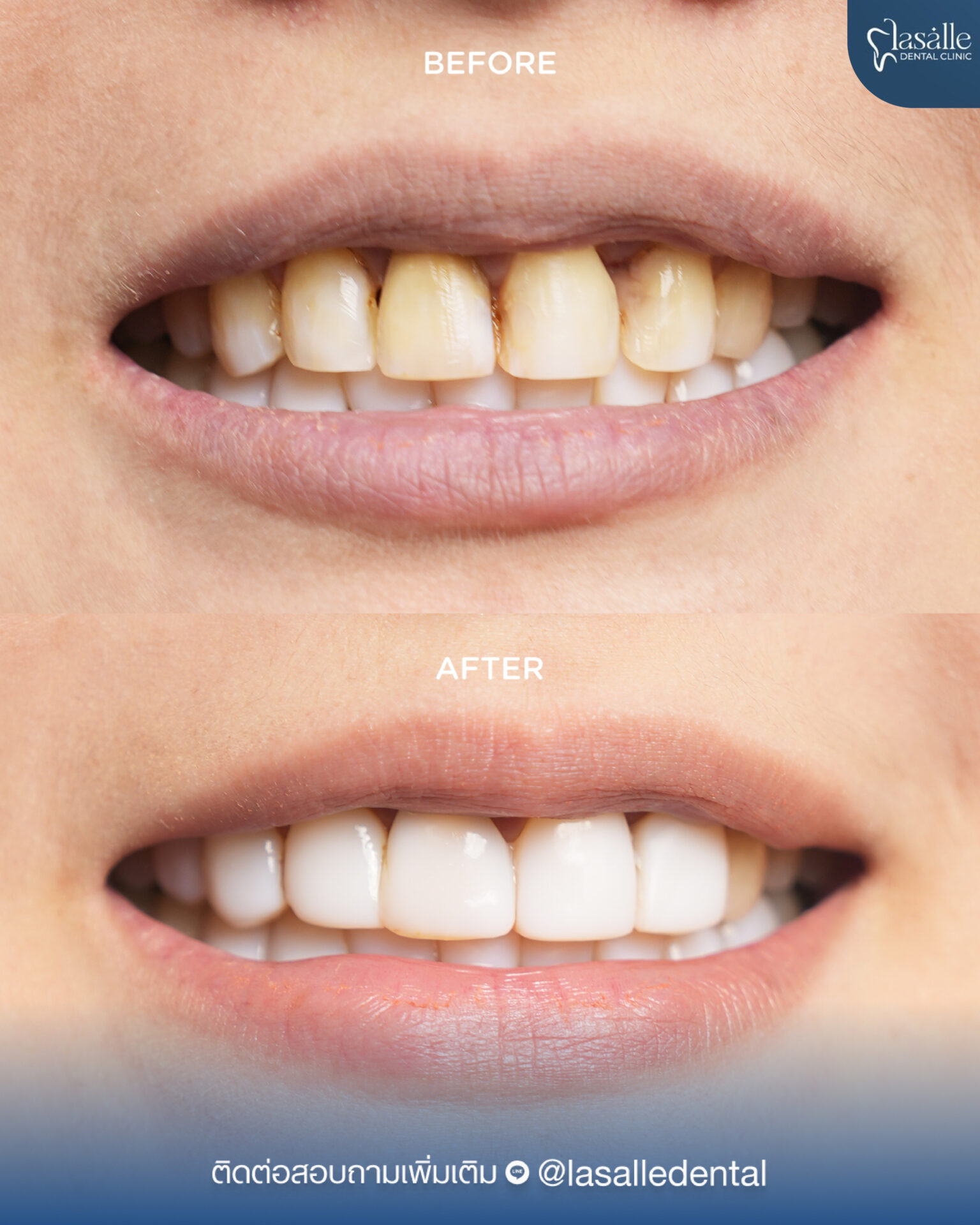 135.Lasalle – Before After คนไข้-02