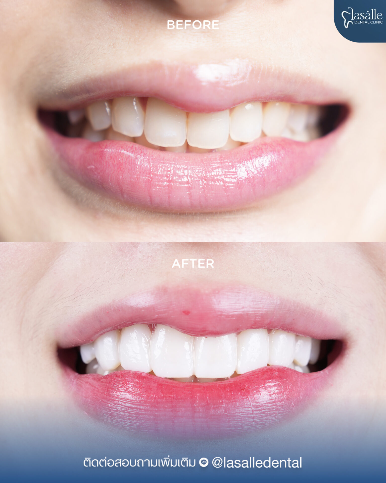 135.Lasalle – Before After คนไข้-03